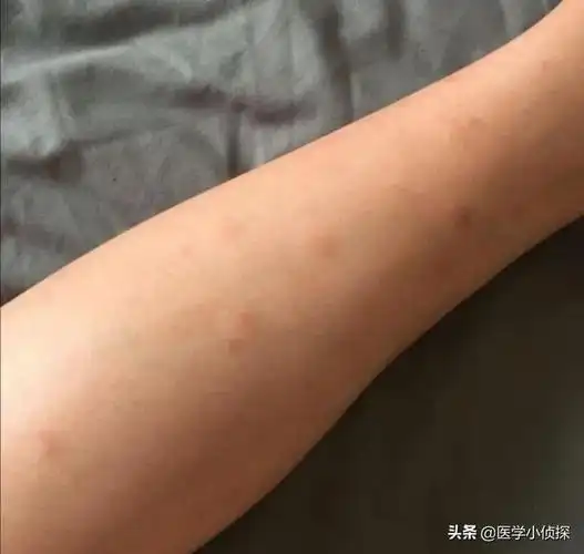 感染艾滋病多久会出现红点