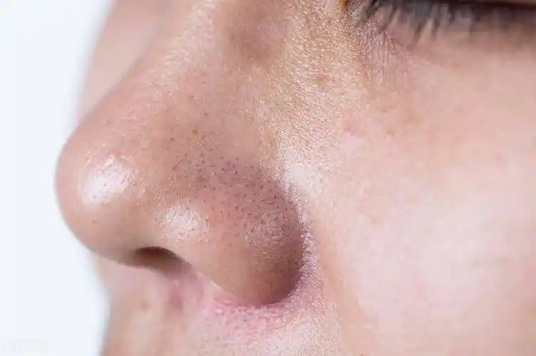 毛孔粗大真的离不开日常护理能救一个是一个