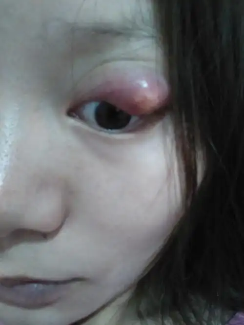 眼睛长包长了20多天了看了3次了这种情况医生说要开刀我