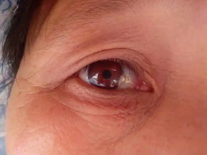 瞳孔缺了一角 有没有问题