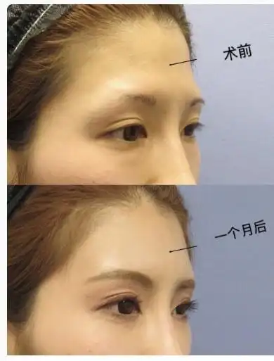 额头玻尿酸填充对比照