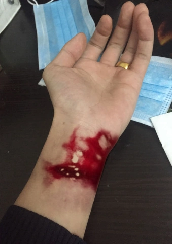 胳膊流血真实图片53