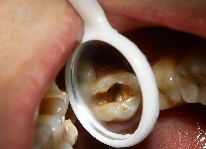 牙齿坏掉图片(3个办法轻松判断牙髓是否坏死) - 赤虎壹号