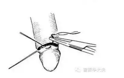 谈古论今话"包皮" - 好大夫在线