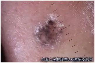 皮肤镜"活眼金睛" 无创辨肿瘤