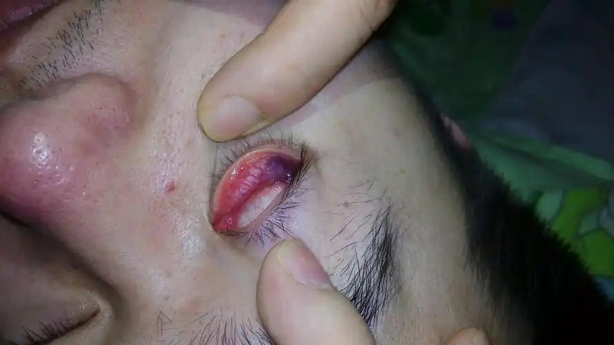 想要请问下,我朋友的右眼不舒服下皮往外翻能看到里面有紫红色像是