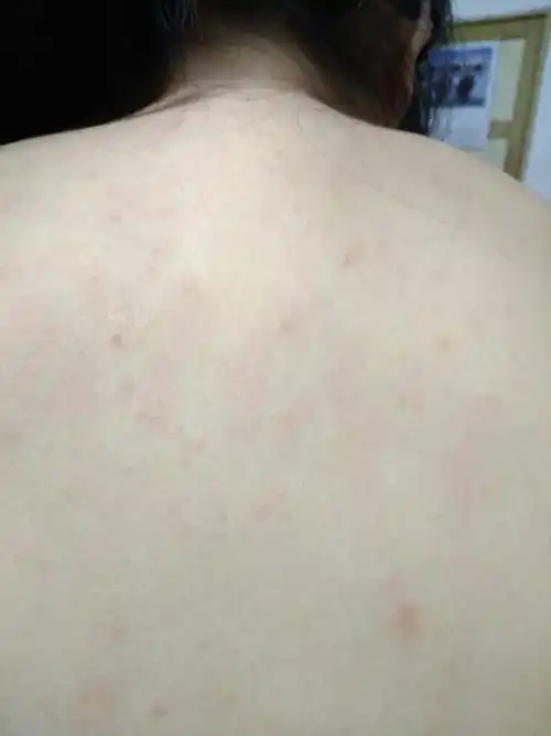 每次洗完澡就红而且痒,皮肤不光滑,是不是过敏啊,背上也有