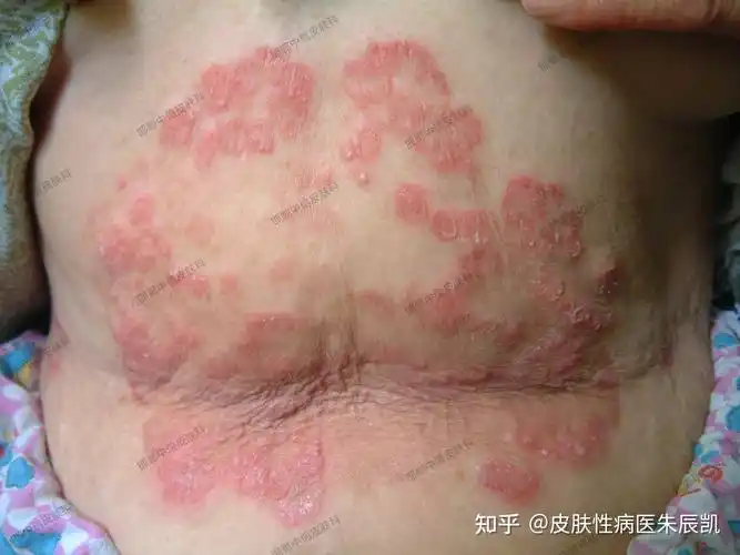 看图识病,皮肤病. - 知乎