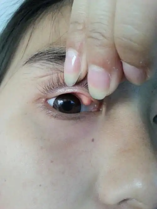 上眼睑长了个包,不痛不痒,也感觉不到,不把眼皮翻开也看不出来,两只