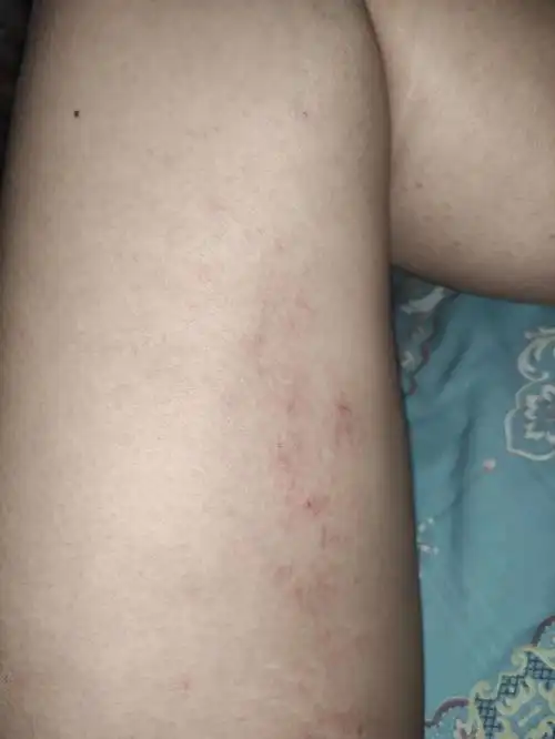 两个大腿内侧一片红疹(不知道是不是这么叫,红点),很痒尤其感觉一到