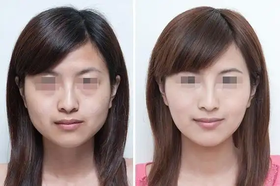 淮安仁爱瘦脸针成功案例