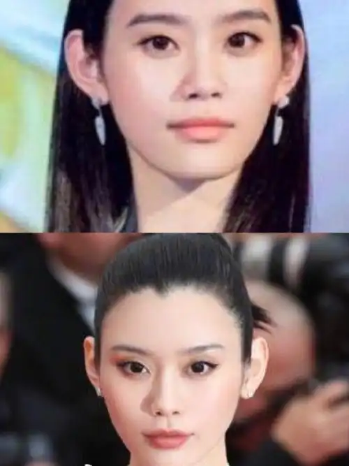 奚梦瑶填充对比奚梦瑶太阳穴奚梦瑶颧弓内推了吗奚梦瑶脂肪填充后照片