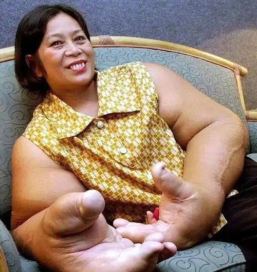 泰国一女子拥有"世界上最大的手