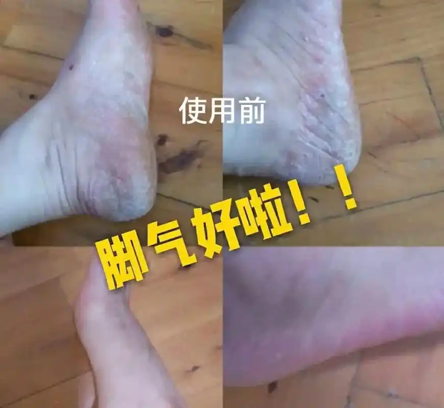 脚气怎么办.神奇的抑菌万能膏 李时珍-藏药脚气克星 一组5盒 - 抖音