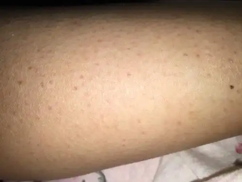 我的小腿上长了红色的小点点 我上网查好像说是什么毛囊炎 我以前从来