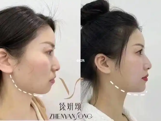 下巴后缩,就是差一个下巴下颌骨