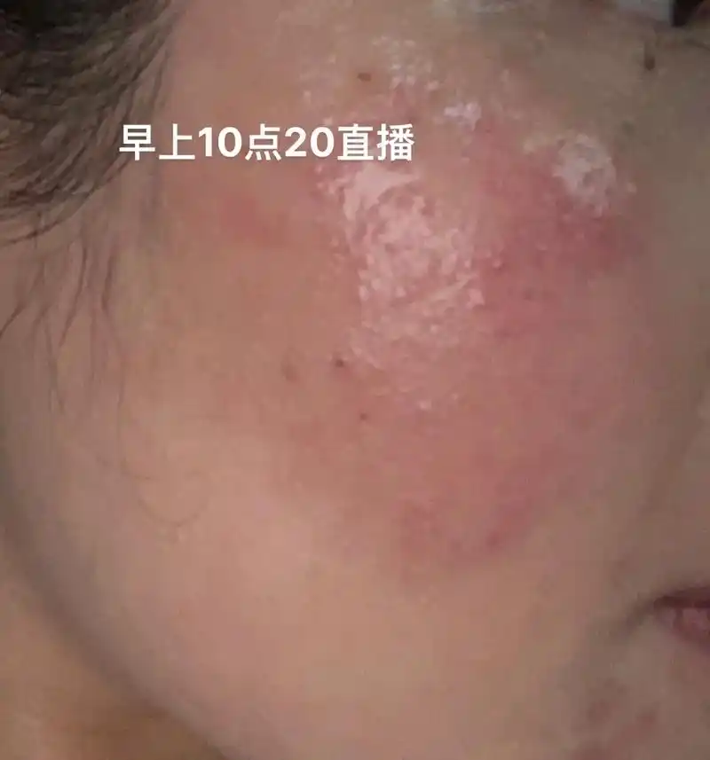 玫瑰痤疮 #敏感肌 #问题性皮肤管理 #脂溢性皮炎 #激素 - 抖音