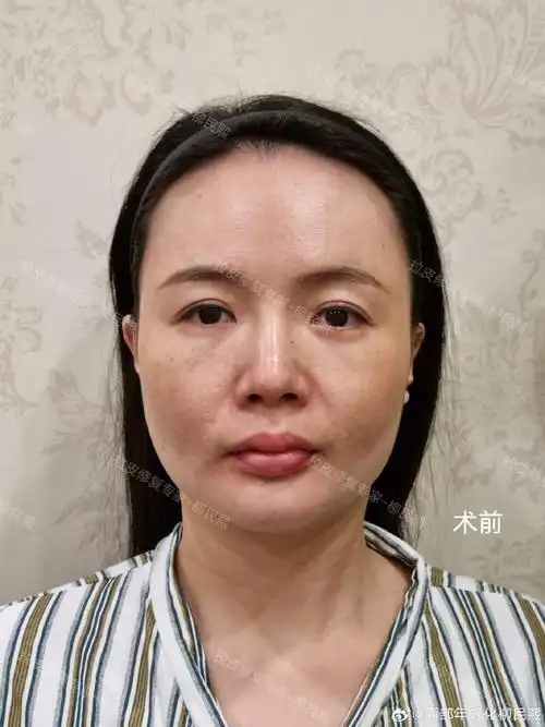 "    【39岁广州顾客"面部提升 颈部提升 脂肪填充"一年3个月分享】
