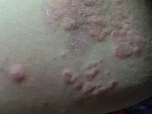 大腿内侧生的东西.不知道什么来的,好痒,怎么办