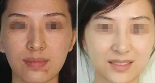 激光美白前后对比图