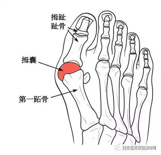 预防及矫正拇外翻俗称大脚骨