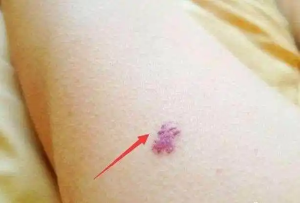 不管男女身上长出这种小红点当心是癌症的征兆