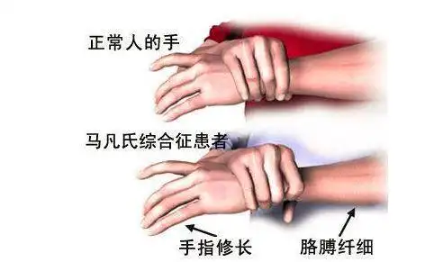 就医搜 | 体型造就的"悲情天才"!马方综合征:为何专挑"巨人"下手?