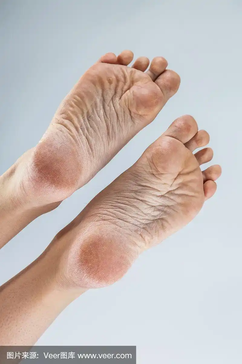 足,干旱,皮肤,女性,脚掌