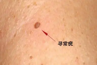 寻常疣图