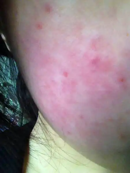 脸皮肤过敏症状图片