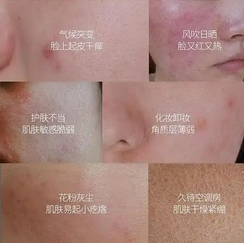 敏感肌可以做的医美项目大盘点,速来get|肤质|舒敏|角质层|敏感肌肤