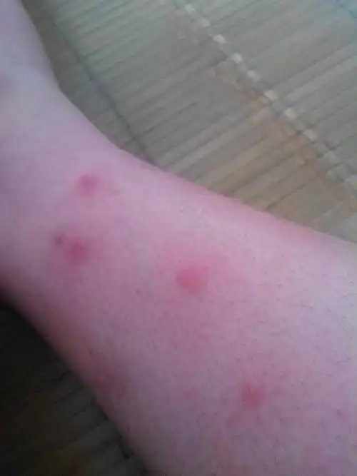 皮肤起红包 像是被蚊子咬一样 非常痒 红疙瘩上小水泡