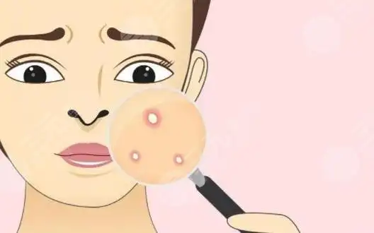 脸颊两侧毛孔粗大