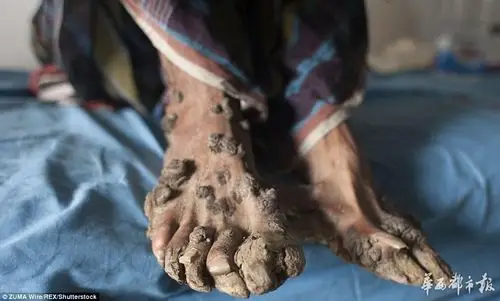 真实树人男子患罕见皮肤病手脚增生如树根