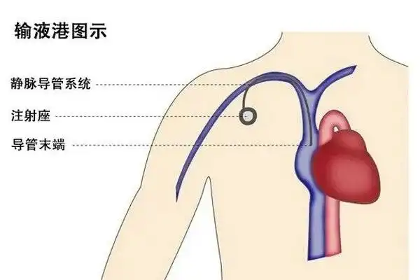 近日,郑州大学五附院肝胆胰腺外科陈升阳主治医师成功
