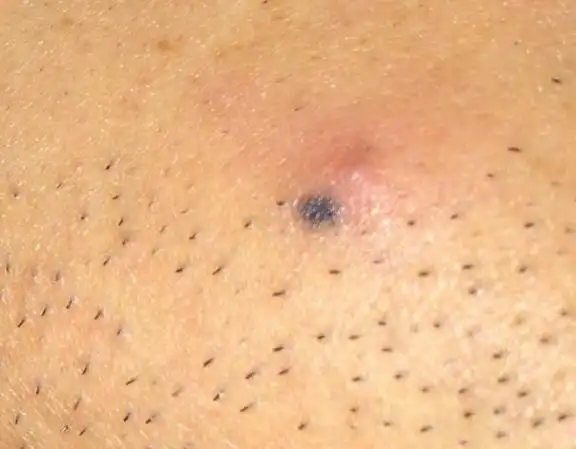 外阴长疖子的症状图片