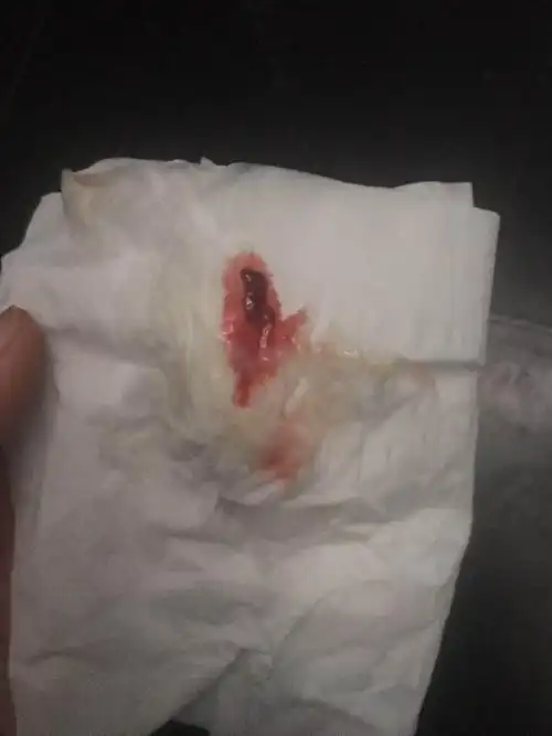 展开全部 怀孕初期出血切勿大意,因为怀孕初期出血可能是先兆流