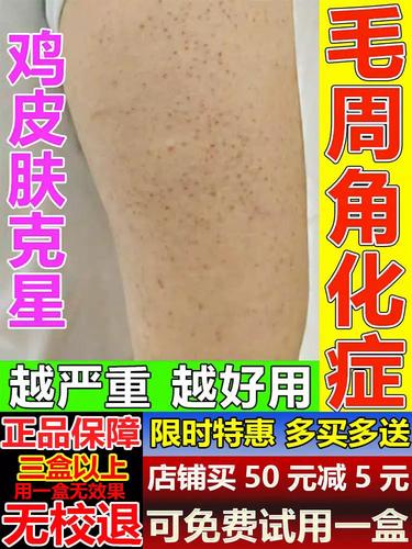 去鸡皮肤疙瘩毛囊角化药膏儿童脸部腿上胳膊上小疙瘩毛囊炎身体乳