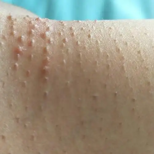 大腿根长了很多小疙瘩,两年了,不痛不痒,挤的话有白色的东西,这是
