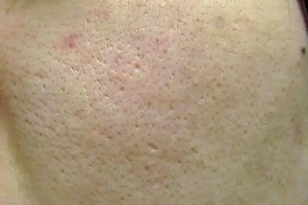 如何正确的膜收缩毛孔