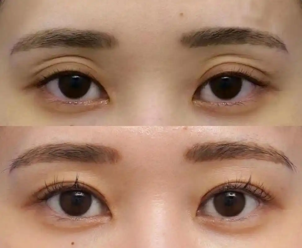 年龄大了眼窝凹陷该怎么解决?