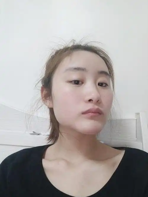 自提体脂肪填充三个月了失败了脸好大好宽丑死了很奇怪怎么办好急啊