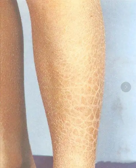 1分钟了解鱼鳞病