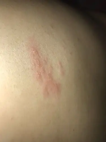 不疼也不痒.请问下这是湿疹还是什么?