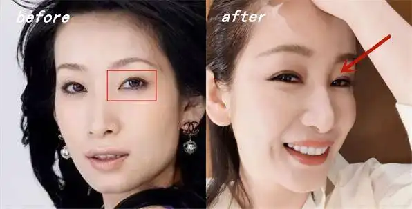 秦海璐因为生完孩子眼泪太多,单眼皮压 迫到睫毛造成倒刺,无奈去做的