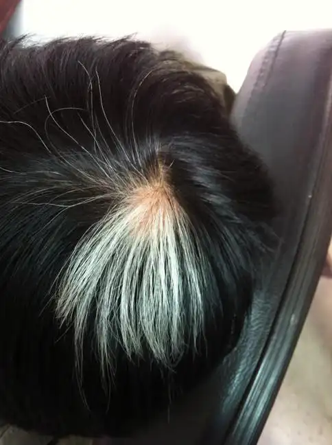 关于头顶上集中长有一片白发