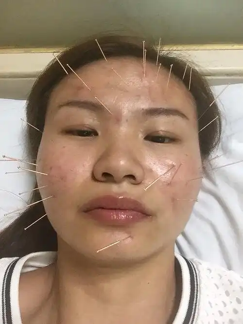 最近在针灸祛痘
