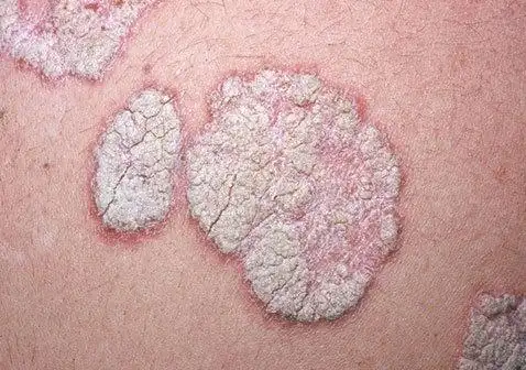 各种片状皮肤病图片及症状_银屑病求医网