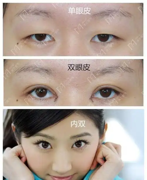 单眼皮可以变成双眼皮吗怎么才能变,不做手术那种
