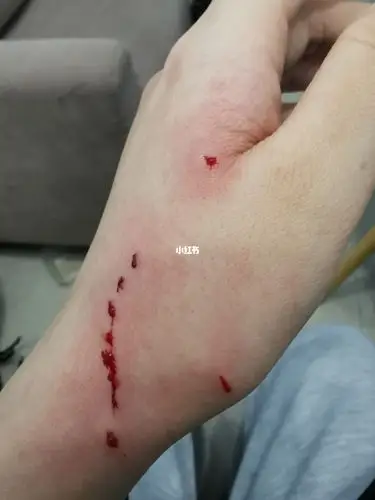 被猫猫咬成这样隔一天打针晚不晚